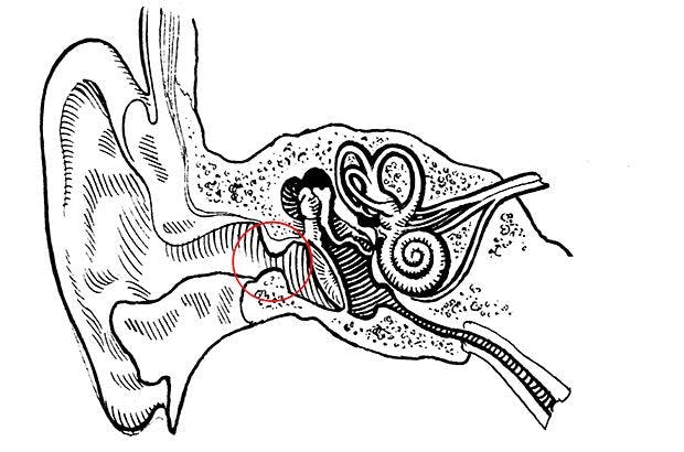 An ear canal with the bony growths (exostosis) of surfer’s ear.