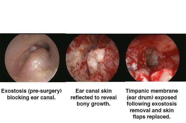 Surgical images from Dr. Phil Flanagan showing the stages of a surfer’s ear exostosis operation.